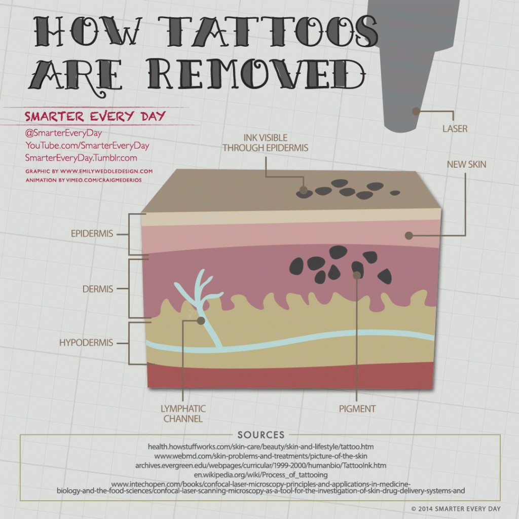usuwanie tatuazu łódź